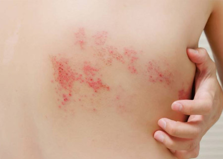 Herpes Zoster