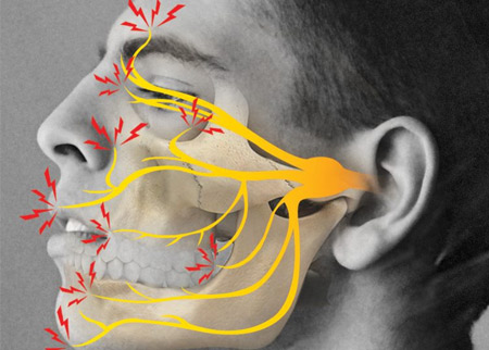 Neuralgia do Trigêmeo